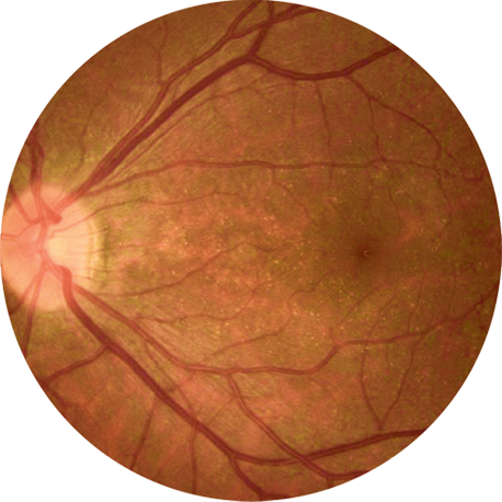 Fundus image of the retina in early-stage BCD patients